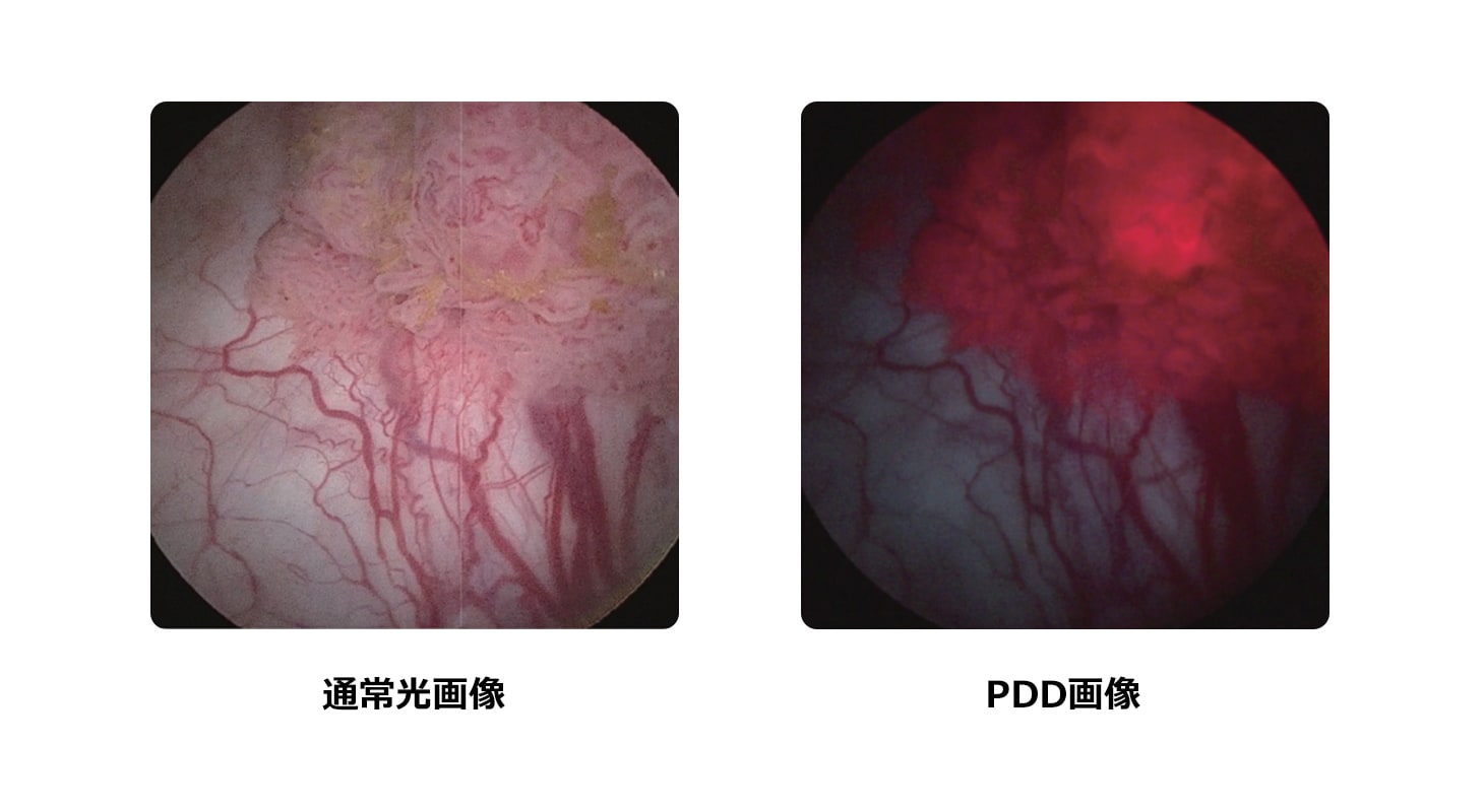 IMAGE1 S™ PDD蛍光内視鏡 – 硬性内視鏡による非侵襲・低侵襲治療 エム・シー・メディカル株式会社