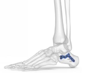 骨折治療手術 | エム・シー・メディカル株式会社