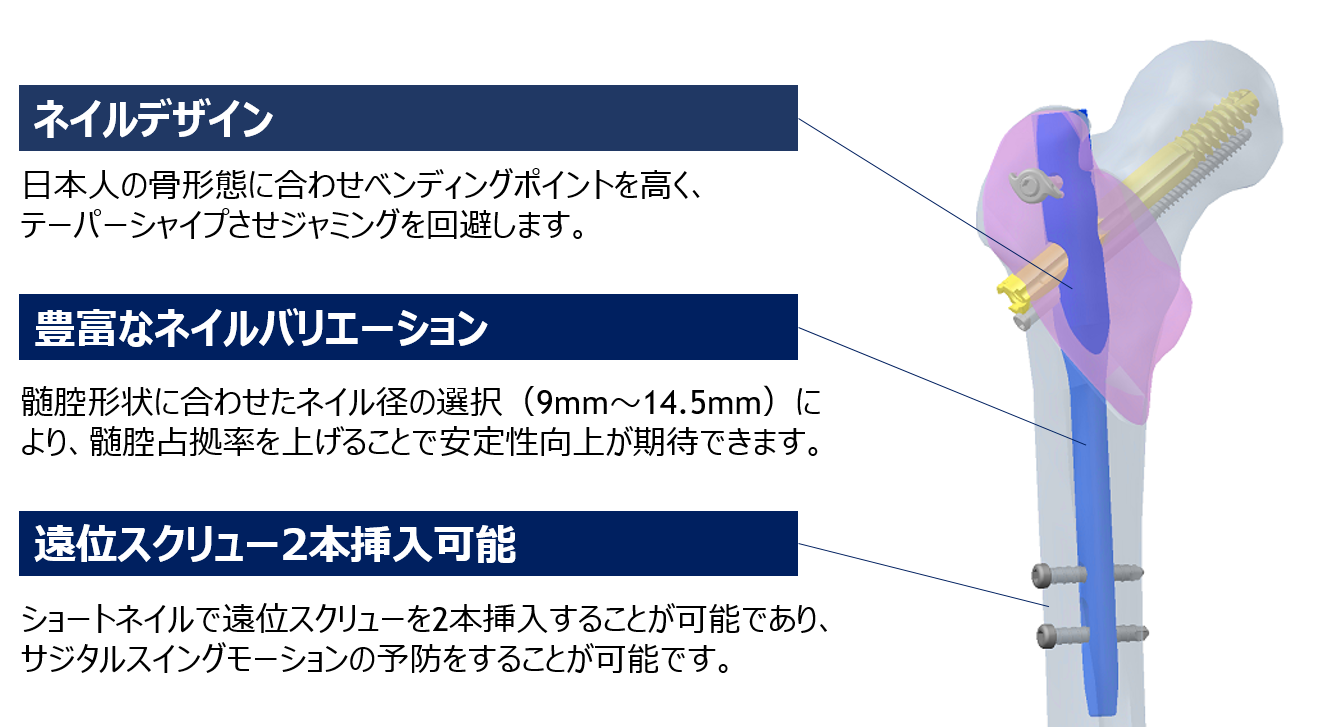 大腿骨近位部骨折用髄内釘 APOLLOFIXネイルシステム | 製品情報 | 硬性 