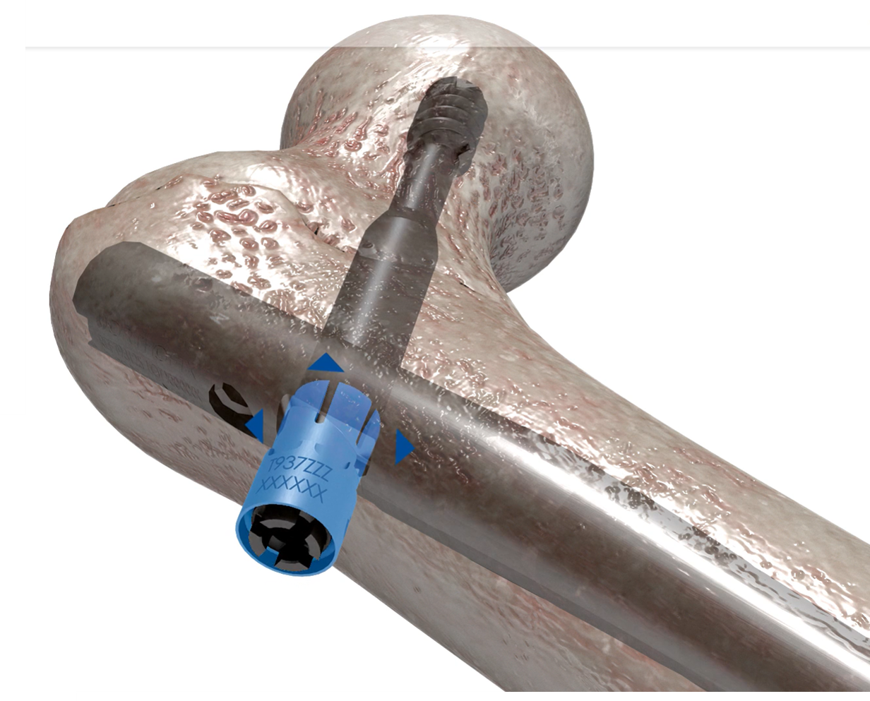 大腿骨転子部用髄内釘 Chimaera Nail | 製品情報 | エム・シー